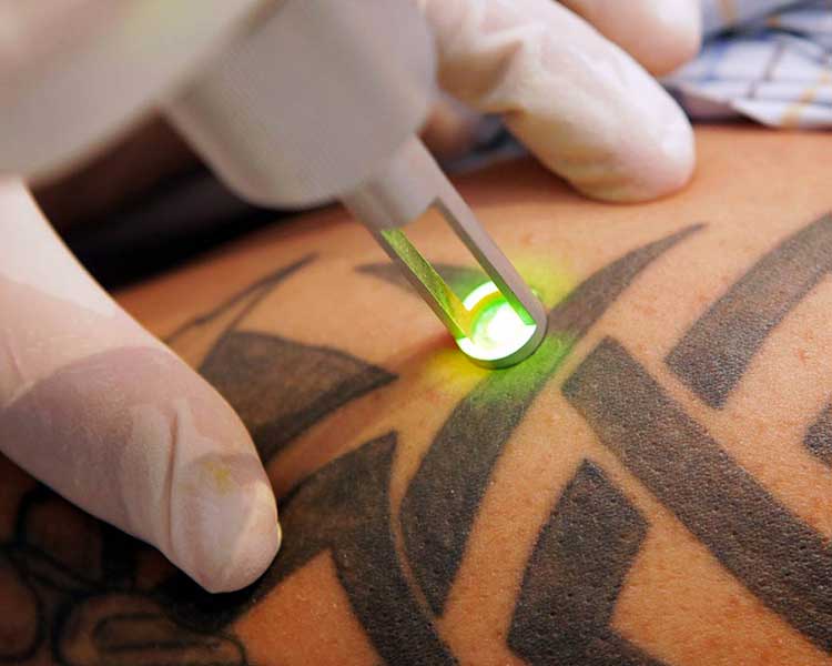 Tattoo removal